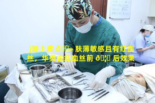 J脸上皮 🌻 肤薄敏感且有红血丝，华羙去红血丝前 🦍 后效果对比如何呢
